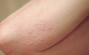 Dị ứng - Hình ảnh minh họa